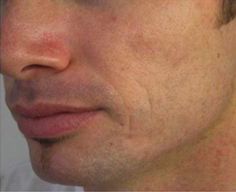 Microneedling Before & After