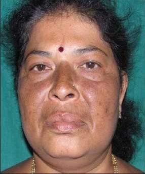 Microneedling Before & After