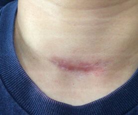 Microneedling Before & After