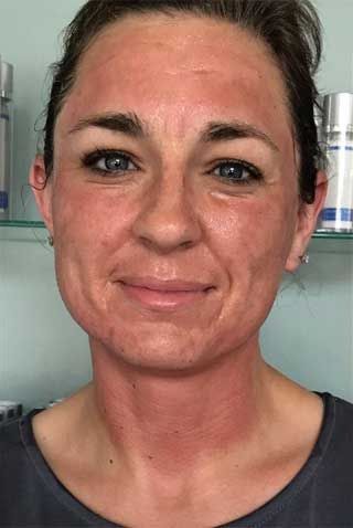 Microneedling Before & After