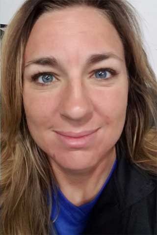 Microneedling Before & After