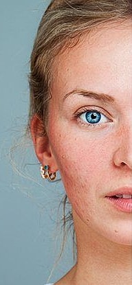 Microneedling Before & After