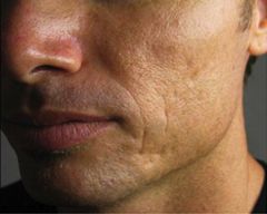 Microneedling Before & After