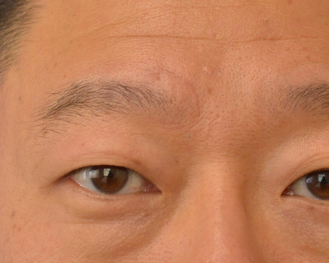 RF Microneedling Before & After