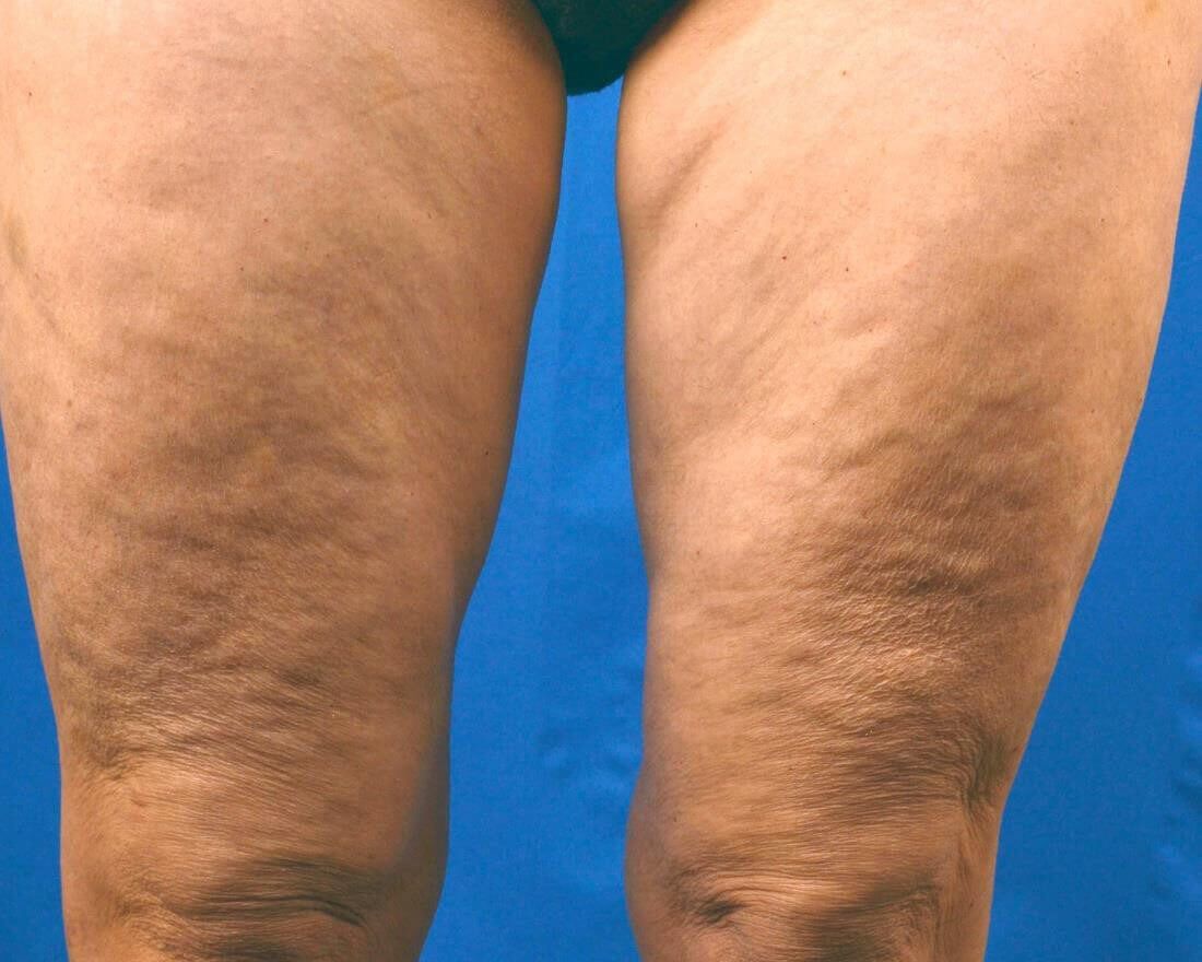 RF Microneedling Before & After