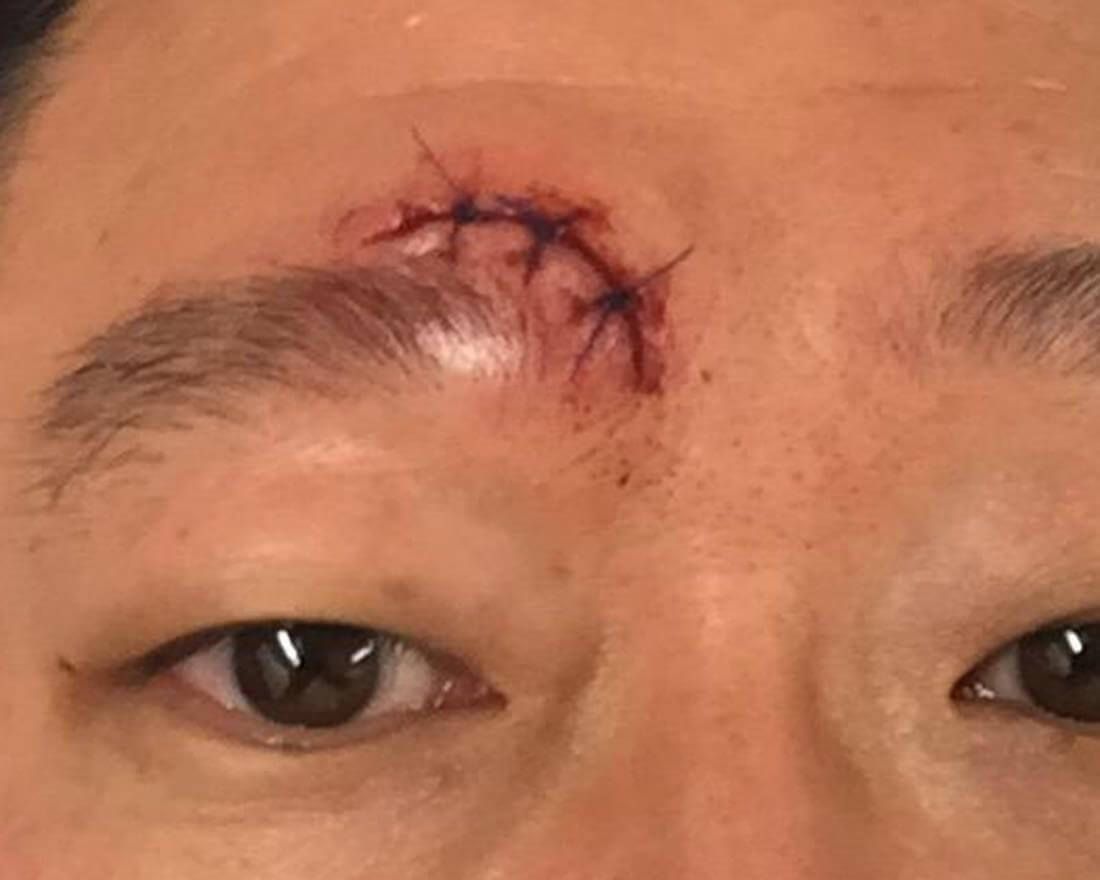 RF Microneedling Before & After