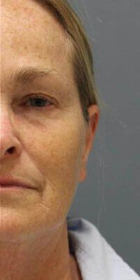 RF Microneedling Before & After