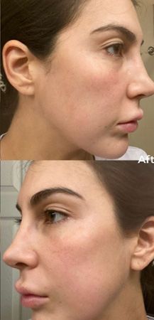 Before and after profile comparison of skin.