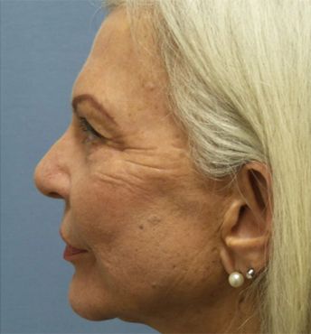Profile of an older woman with gray hair.