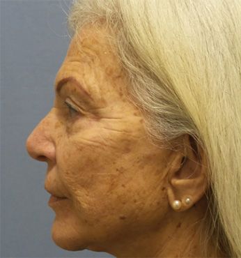 Profile of an older woman with gray hair.