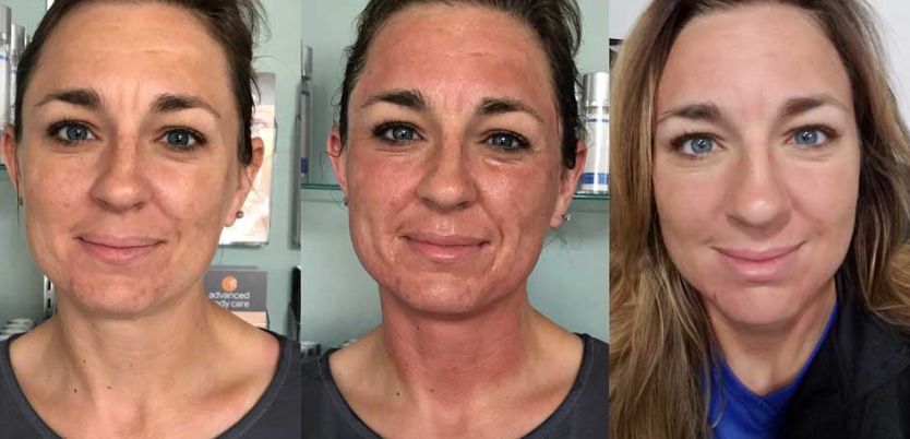 Before and after skincare treatment photos.