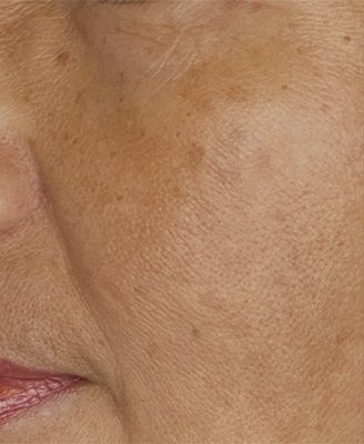 Close-up of textured skin on a face.
