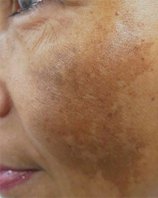 Close-up of skin showing discoloration and texture.