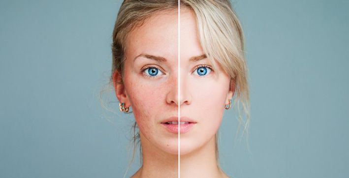 Side-by-side comparison of skincare results.