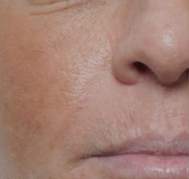 Close-up of facial skin texture and features.