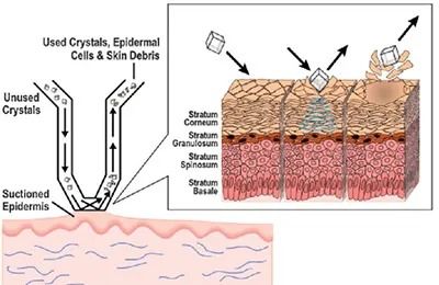 Skin exfoliation process with crystals illustration.