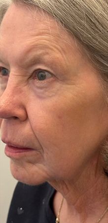 Profile of an older woman with gray hair.