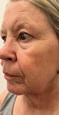 Profile of an older woman with fine lines.