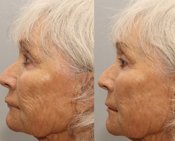 Before and after Santa Fe dermal filler treatment, Skinvive.