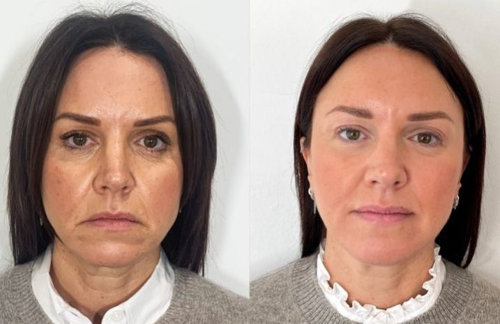 Before and after Santa Fe dermal filler treatment.