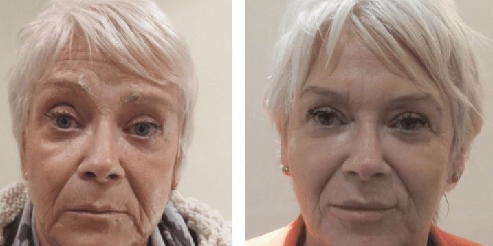 Before and after Santa Fe dermal filler treatment.