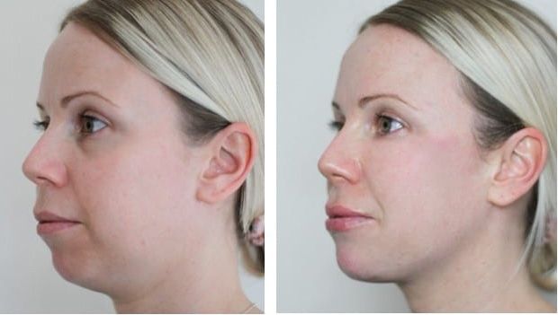 Before and after Santa Fe dermal filler treatment, for jawline.