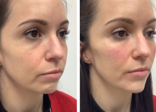 Before and after Santa Fe dermal filler treatment.
