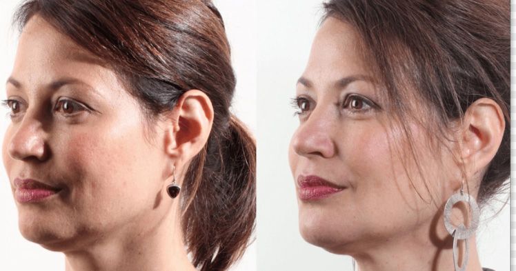Before and after Santa Fe dermal filler treatment on face.