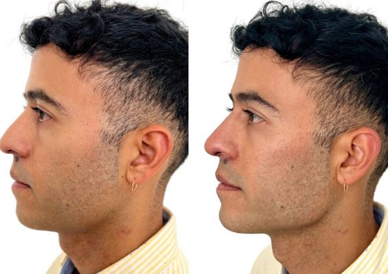 Before and after men's Santa Fe dermal filler treatment.