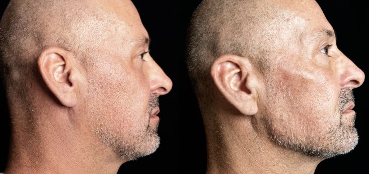 Before and after male dermal filler treatment in Santa Fe.