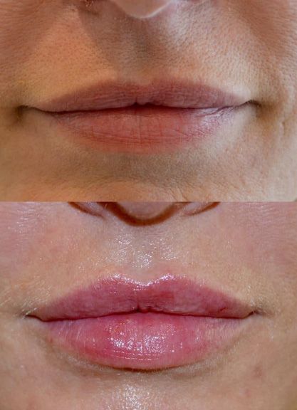 Before and after Santa Fe dermal filler treatment, for lips.
