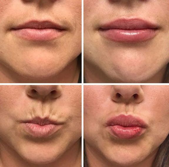 Before and after Santa Fe dermal filler lip treatment.