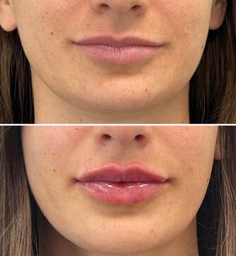 Before and after Santa Fe dermal filler lip enhancement.