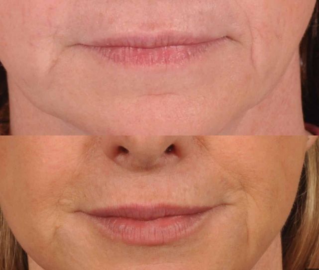 Before and after Santa Fe dermal filler treatment.