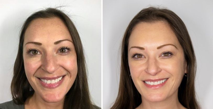 Before and after Santa Fe dermal filler treatment on nasolabial folds.
