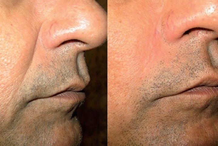 Before and after Santa Fe dermal filler treatment on wrinkle.