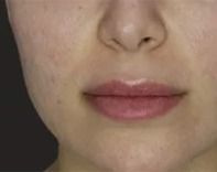 Hyaluronidase After.