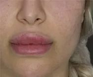 Hyaluronidase Before.