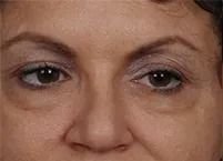 Before hyaluronidase injection.