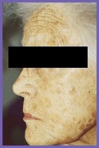 Aging skin with prominent wrinkles and discoloration.