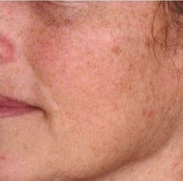 Close-up of textured skin on a woman's cheek.