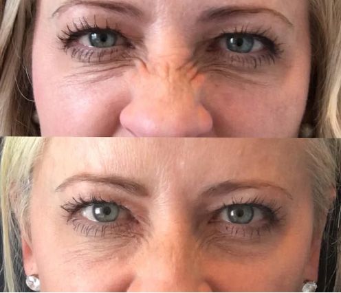 Santa Fe Botox before and afters, nose scrunches.