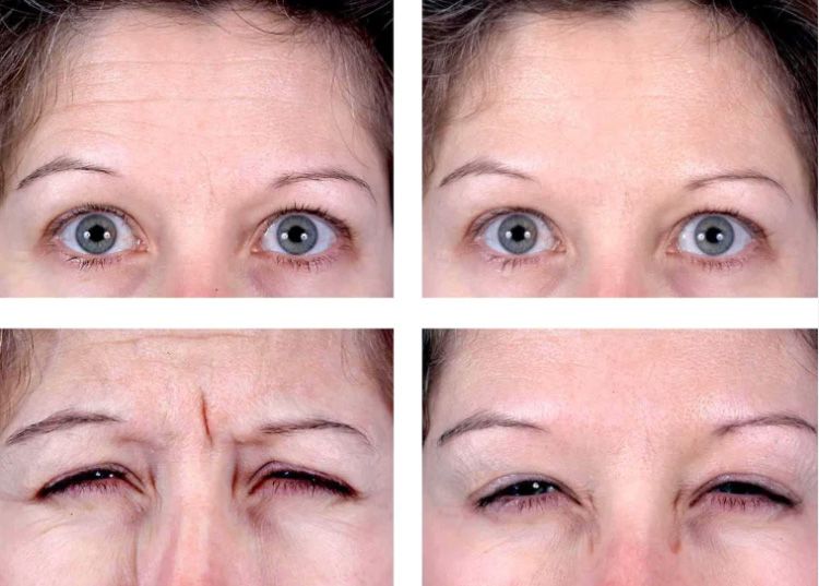 Santa Fe Botox before and afters.