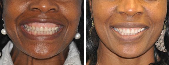 Santa Fe Botox before and afters, gummy smile.