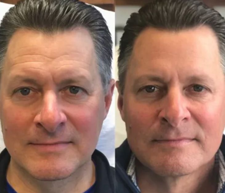 Santa Fe Botox before and afters.
