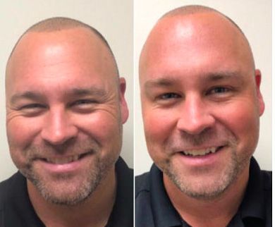 Santa Fe Botox before and afters.