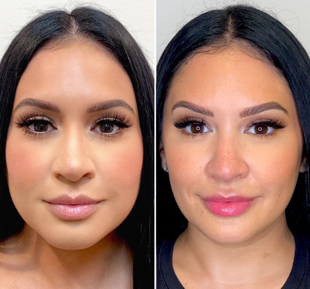 Santa Fe Botox before and afters.