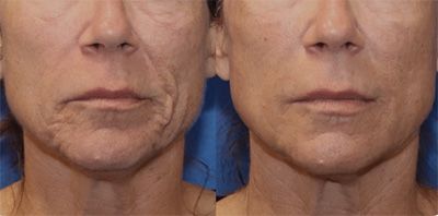 Before and after facial skin treatment comparison.