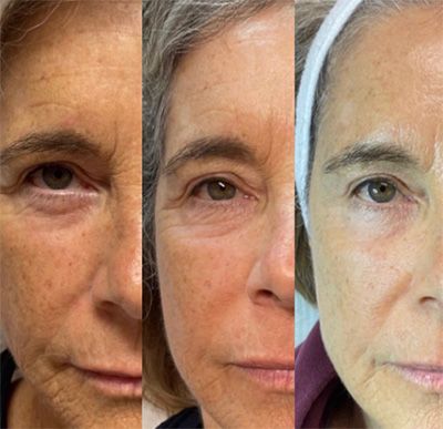 Before and after skin treatment comparison photos.