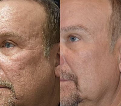 Before and after facial rejuvenation comparison.